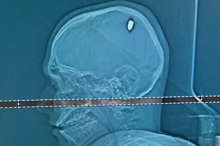 Jovem é atingido por bala perdida na cabeça e só percebe 4 dias depois