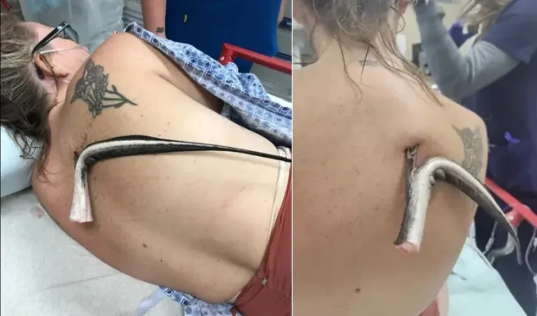Banhista fica com ferrão de arraia cravado nas costas após entrar no mar